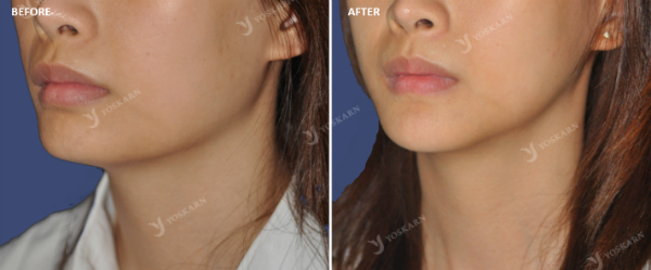 Chin Implant 4[1].png (600×249)